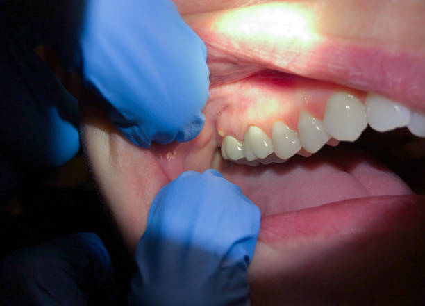 Best Emergency Dental Care for Abscessed Tooth in Garland, NC